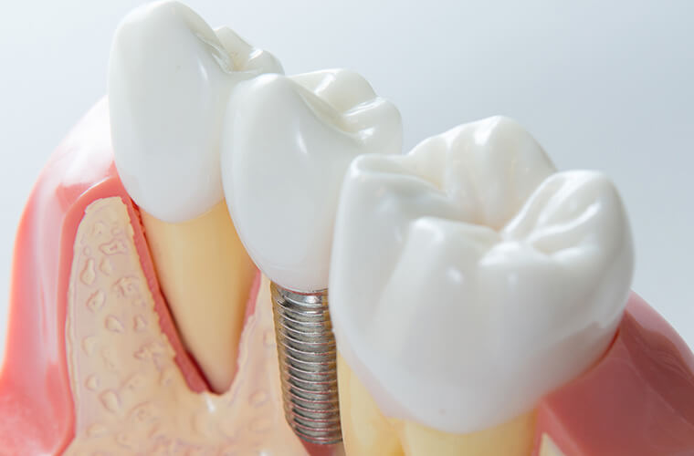 dental implants Lublin